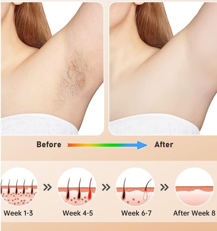 لیزر موهای زائد زیر بغل