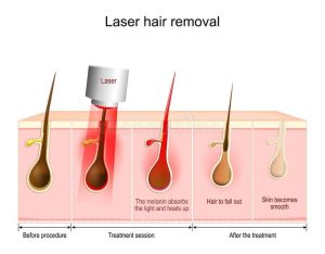 نحوه عملکرد لیزر موهای زائد