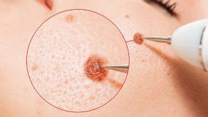 خال برداری سطحی