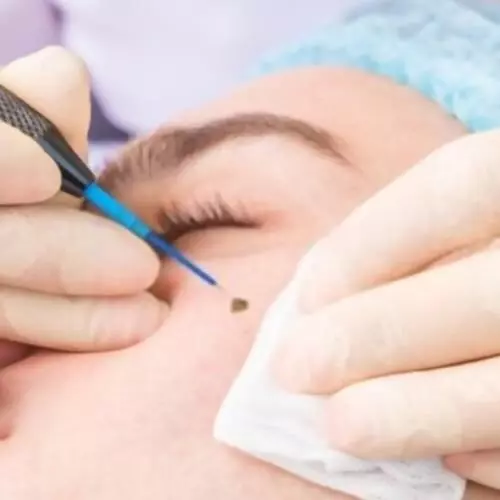 خالبرداری سطحی