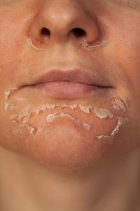 لایه برداری پوست ماری