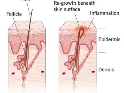 درمان موهای زیرپوستی با لیزر موهای زائد